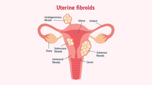 Uterine Conditions | Petals Health